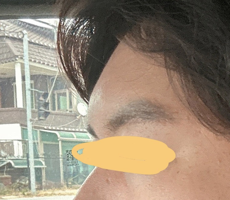 남자지방이식후기! 한달됐습니다