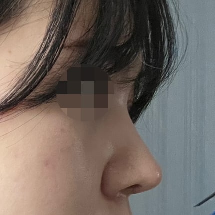 코수술 받고 3개월차 다들 제 코인줄 알아요 ㅎㅎ