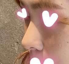 무보형물코성형 한달됐어욥