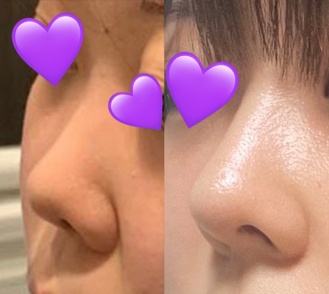 복코+짧은코가 예쁜코됐어요 ㅎㅎ