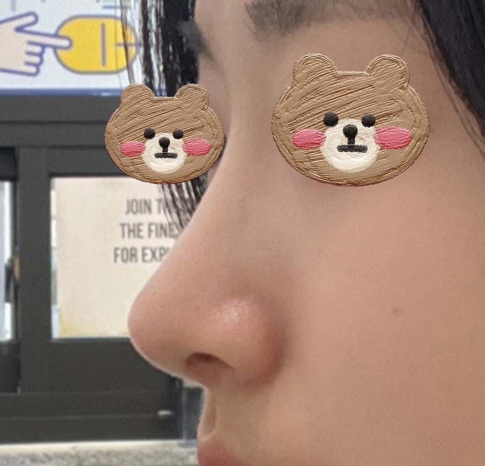 무보형물 코성형 7개월차되고 후기써요~