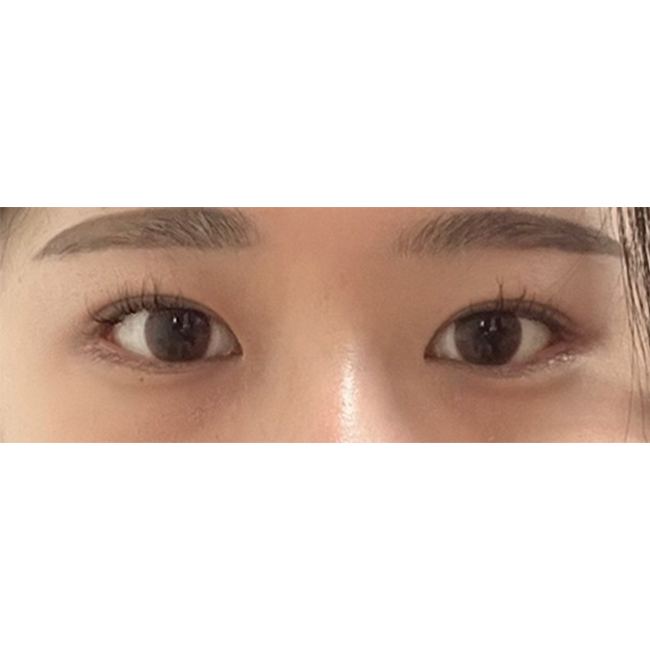 짝눈에 졸려보이는 눈ㅠ이제 또렷해보여요ㅎㅎ