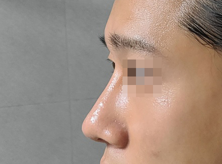 남자코성형 3개월차후기입니다.