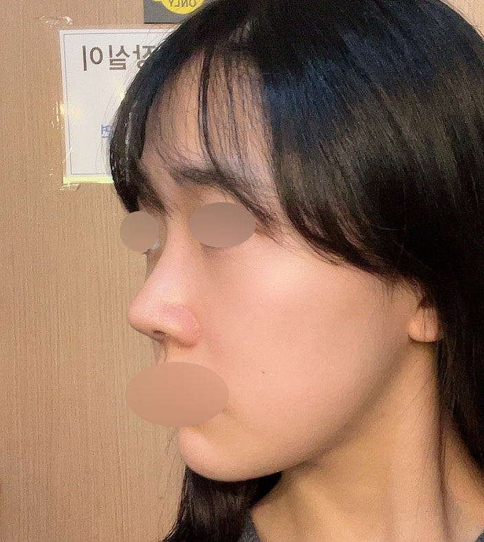 수술후_2_-코.jpg