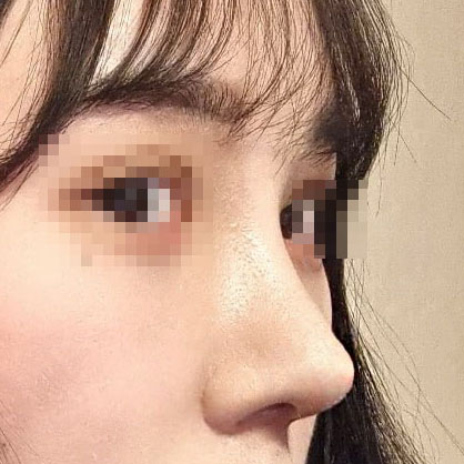 유영문 원장님한테 수술받은지 3주차^^