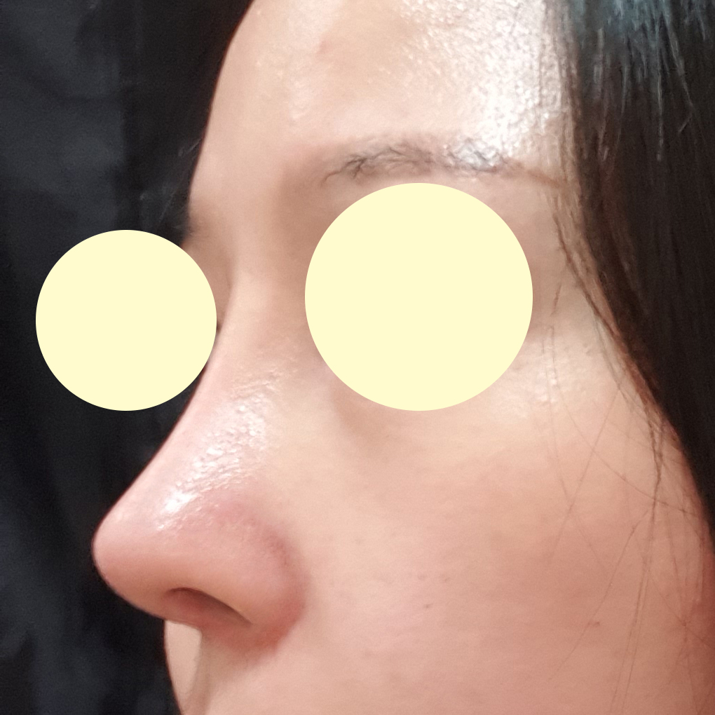 절개쌍꺼풀 + 코재수술