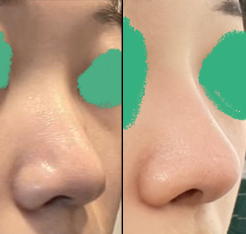 코수술고민한다면 바이브 적극추천합니닷