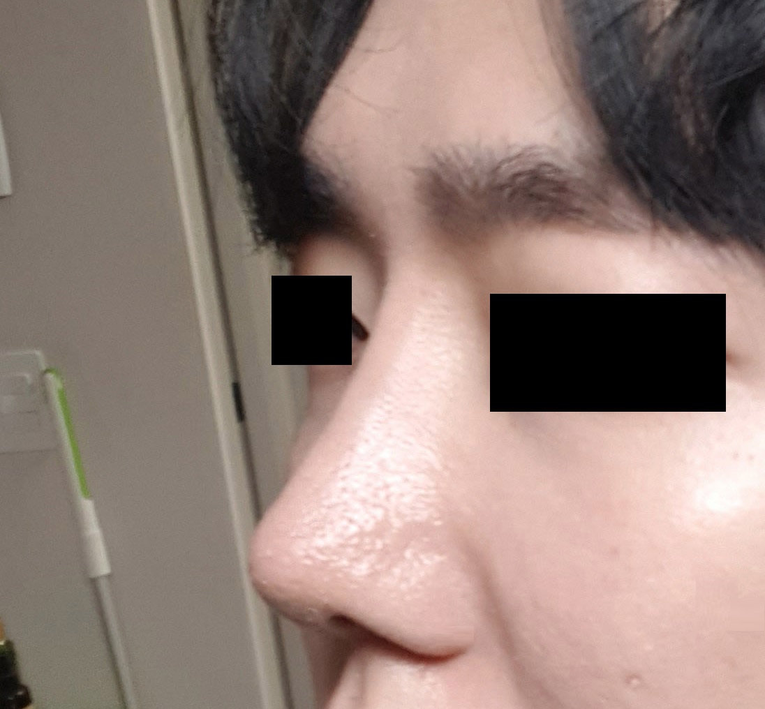 남자코성형 잘선택했어요