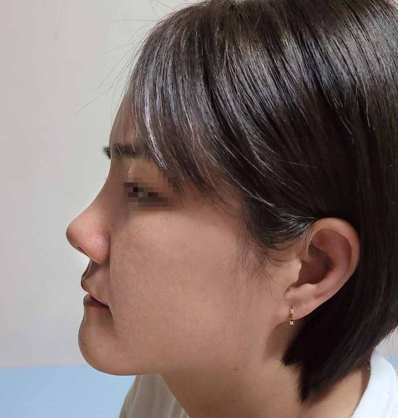 코재수술 자연스럽게 너무 잘됐어요~