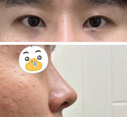 첫코, 첫눈수술 만족합니다!