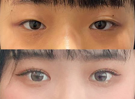 눈성형 만족해용