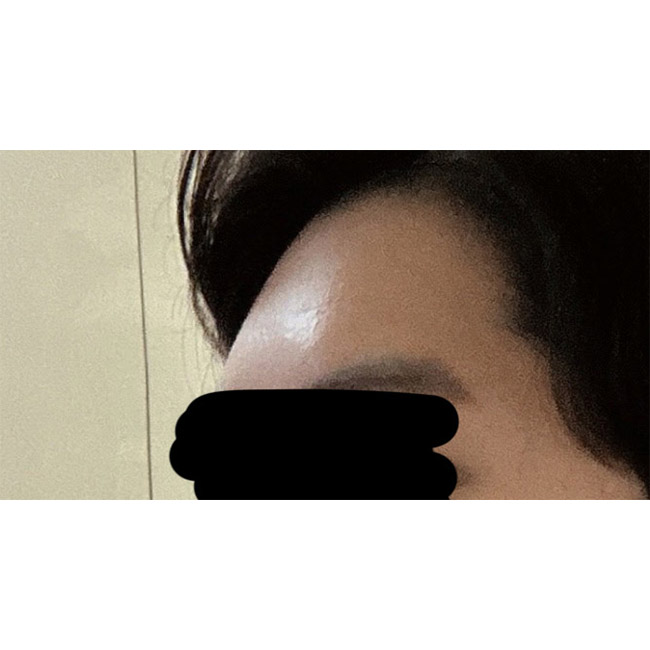 남자지방이식 4달차후기입니다.