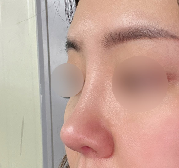 복코수술7개월차^0^