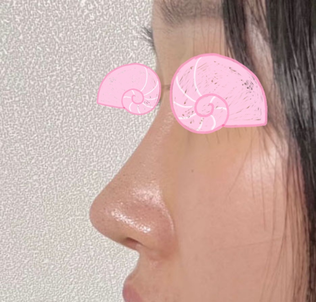 눈재&첫코 6개월 지나 후기 적습니다~