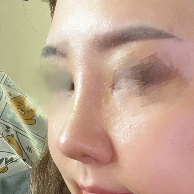 수술 후 2주찬데 라인이 넘 예뿜