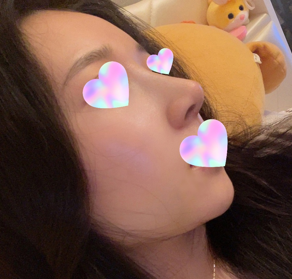 코성형 후회없어요:)