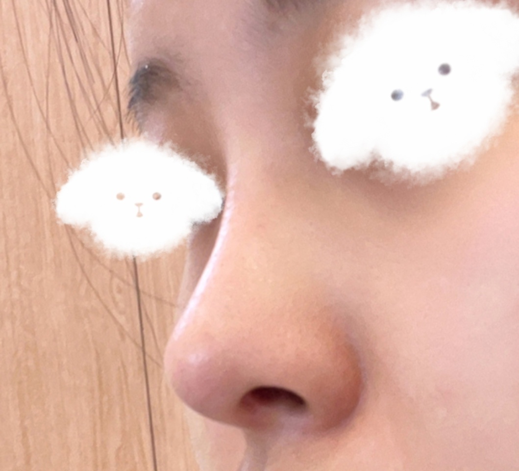 코수술은 유영문원장님 추천!!