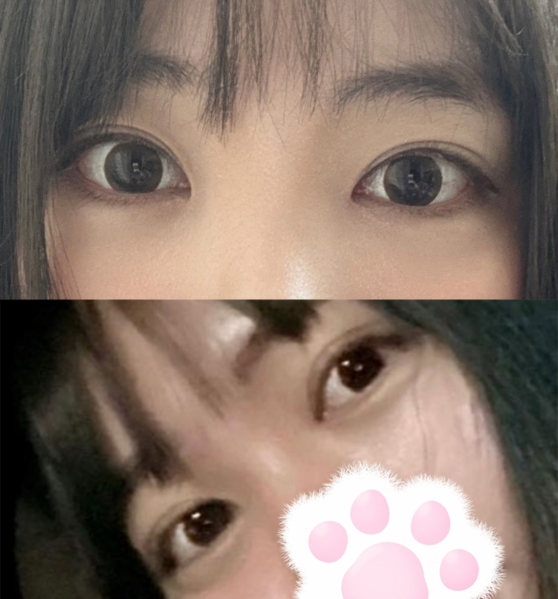 쌍꺼풀하고 존예눈됐어요!!