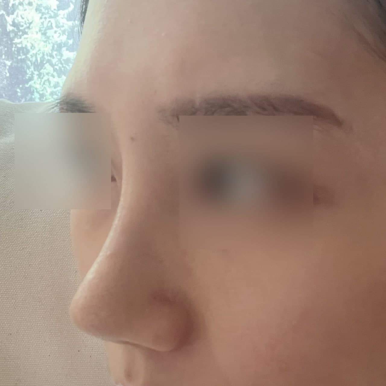 바이브성형외과 코수술 인정