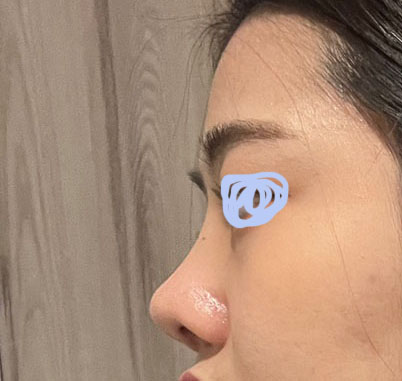 낮았던 코, 원하던 직반으로 오똑하게 됐어요ㅎㅎ