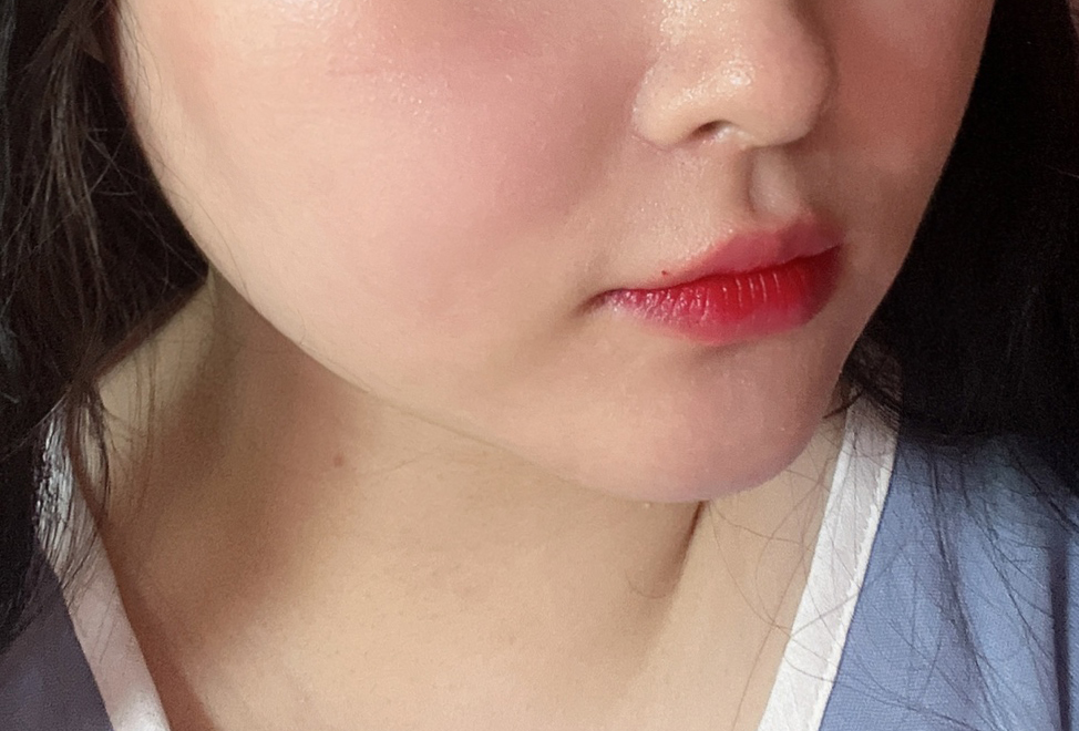 이중턱지흡 효과 진짜 너무 좋아요..!