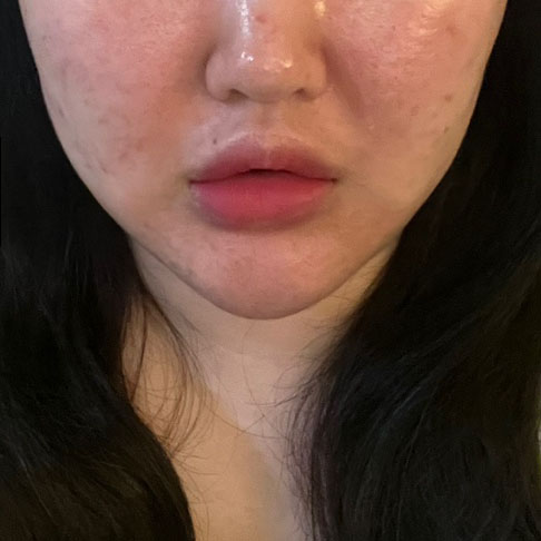 턱살 다 없어졌어요ㅠㅠ