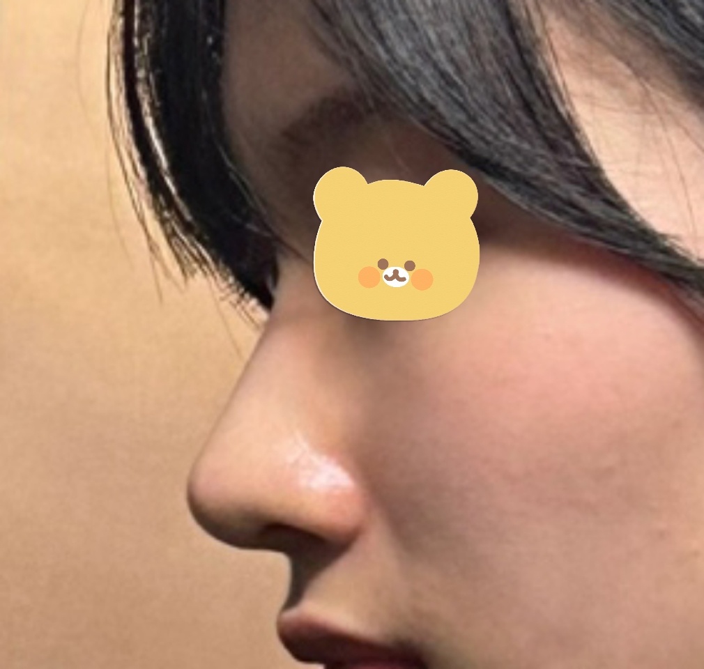 매부리코교정 너무 잘됐어요 ㅠ전후차이대박