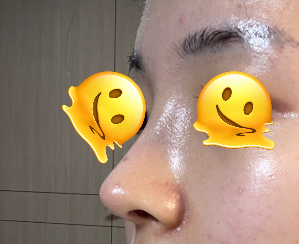 코재수술 잘돼써요!