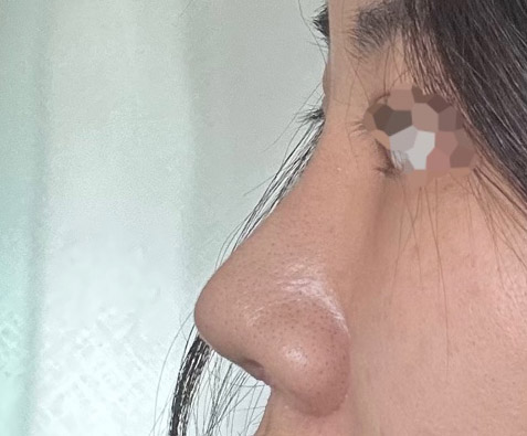 코재수술했는데 예쁘게 잘됐어요