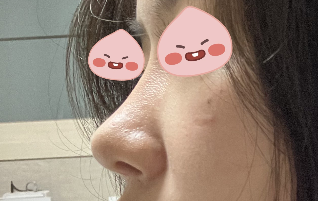 코성형알아보신다면 바이브 추천추천!!