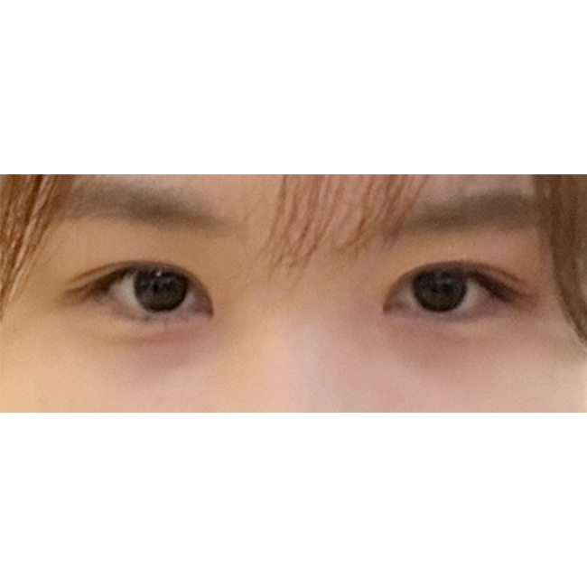 눈매교정&앞트임후기입니닷