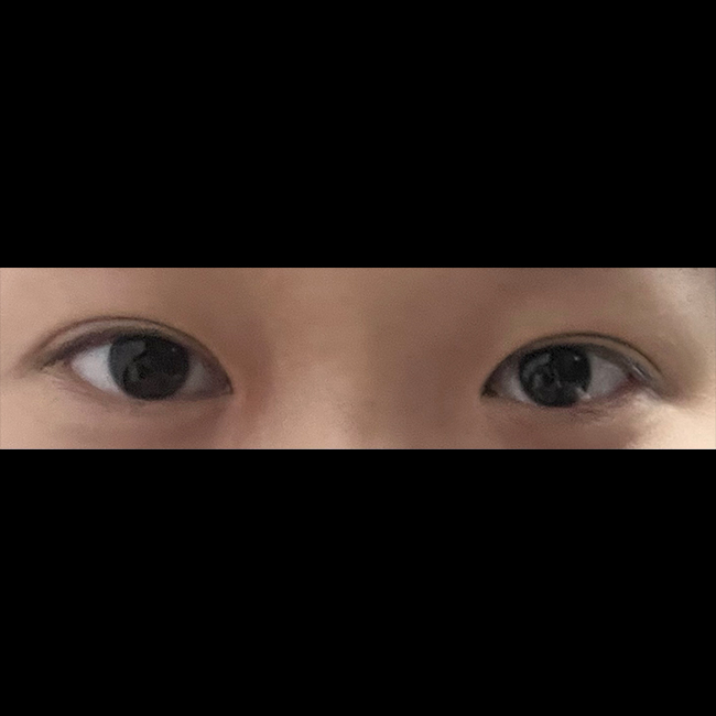 눈매교정이랑 앞트임받았어요!