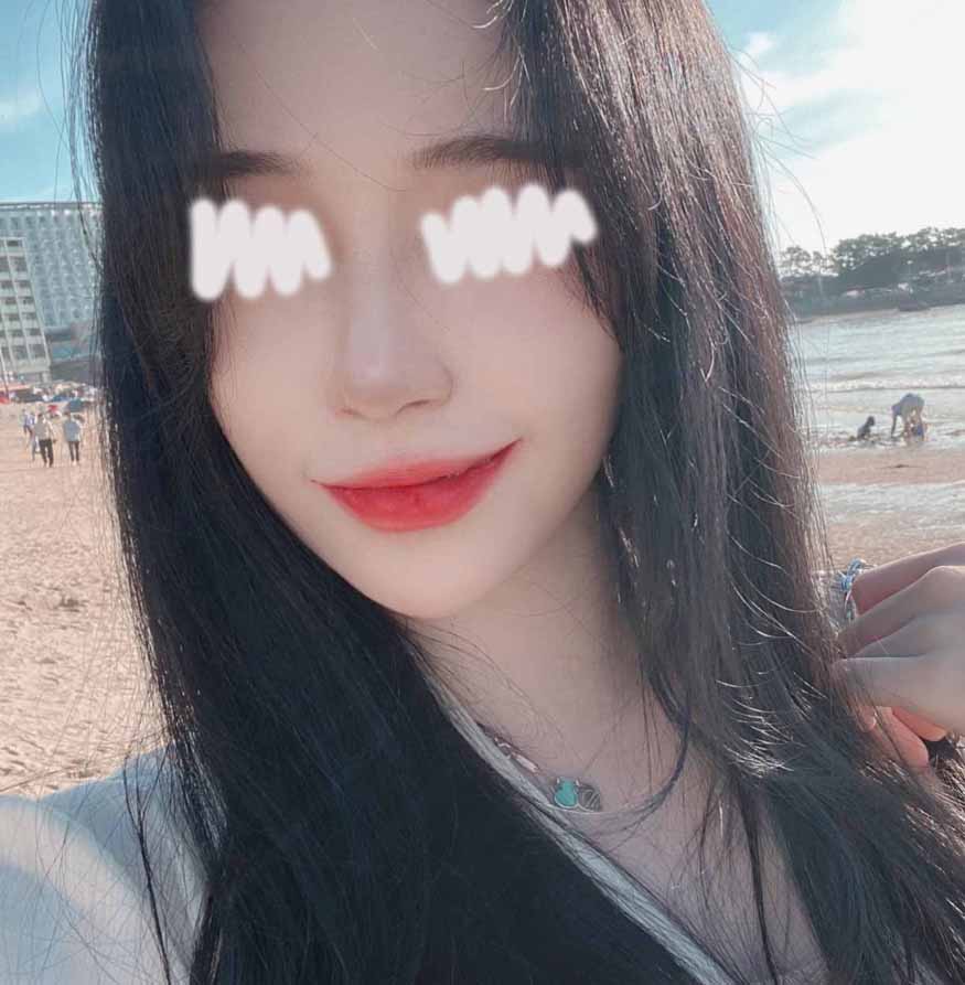 코 수술한지 3개월차+지방흡입1달차