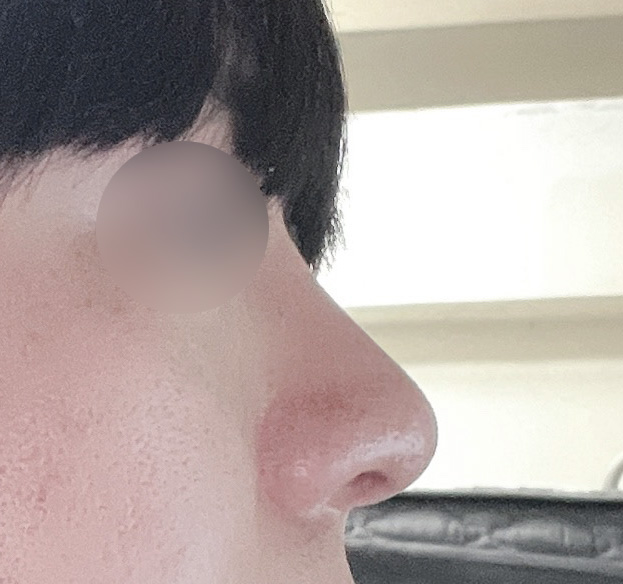 눈, 코성형 두달차! 전후비교사진 보여드려요!