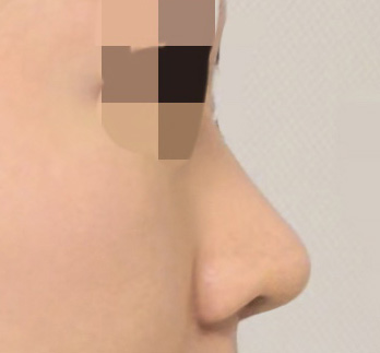 후기보고 맘에 들어서 수술했어요 ㅎㅎ후회XX