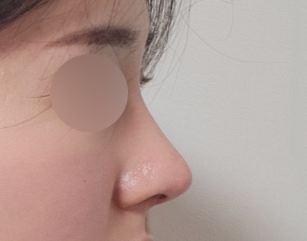 코성형찾으시면 바이브추천해요:)