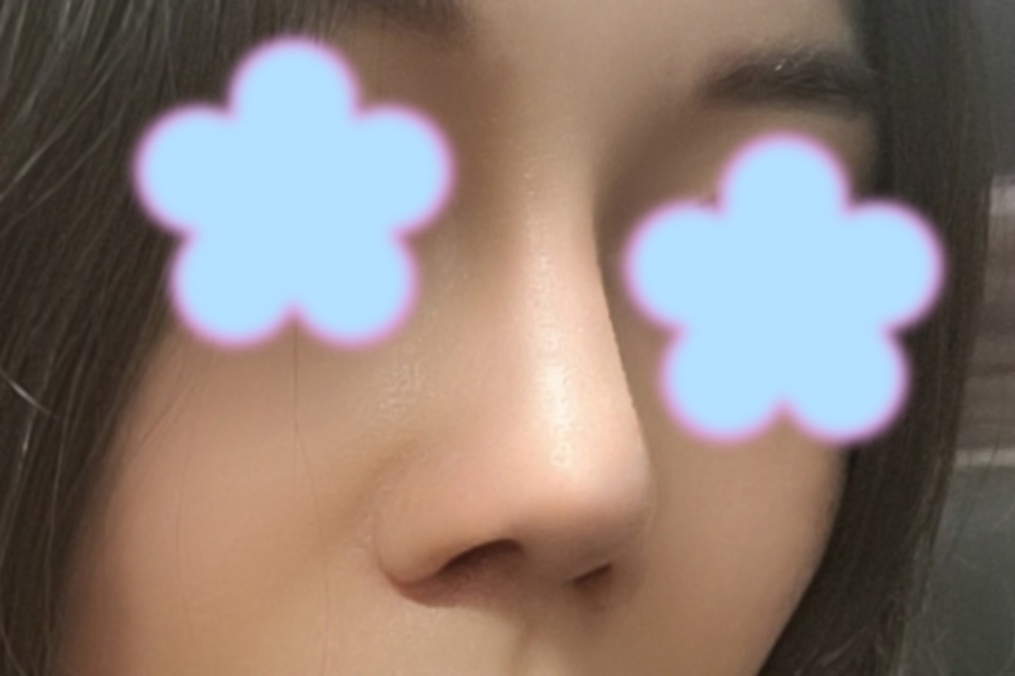 코재수술 3개월차입니다!