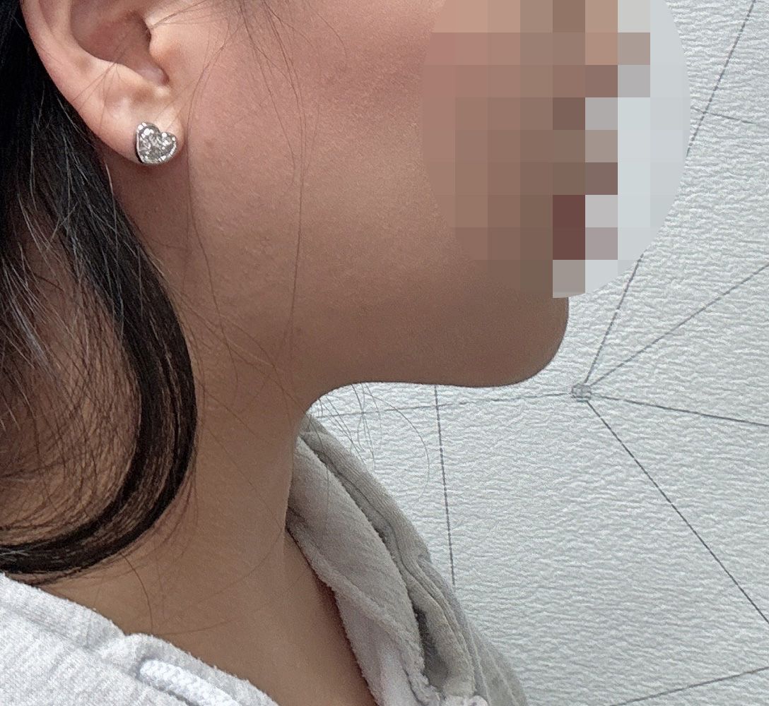 이중턱지흡 후회1도 없어요!