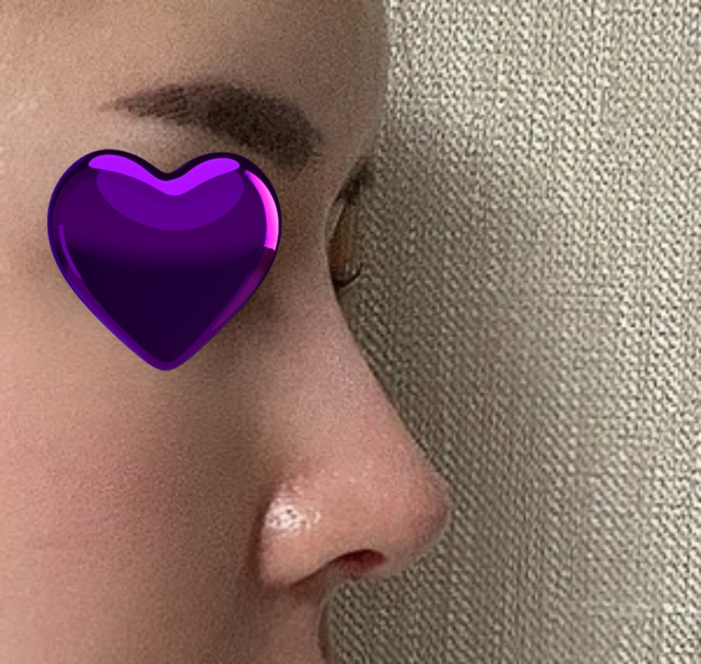 코성형 200%만족 후기