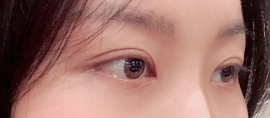 눈재수술 할꺼면 당장 여기로 고고