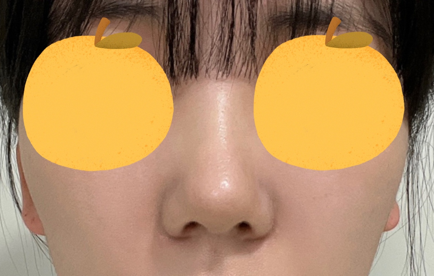 무보형물코수술 2달차 되고 후기씁니다:)