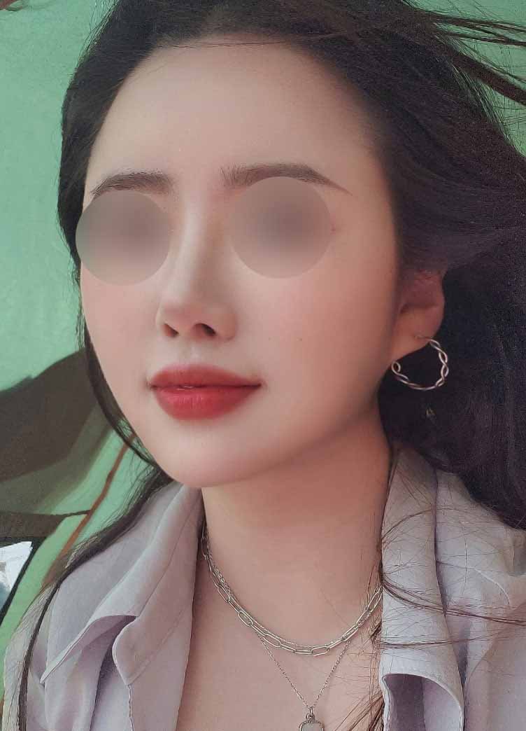 눈+지방이식+흡입 내돈내산 후기