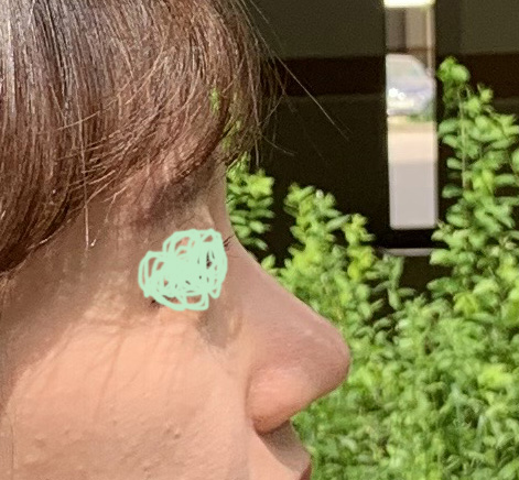 무보형물코성형 후기 1달차~!