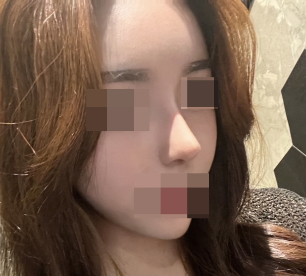 코성형이랑 지방이식 바이브 강추!!