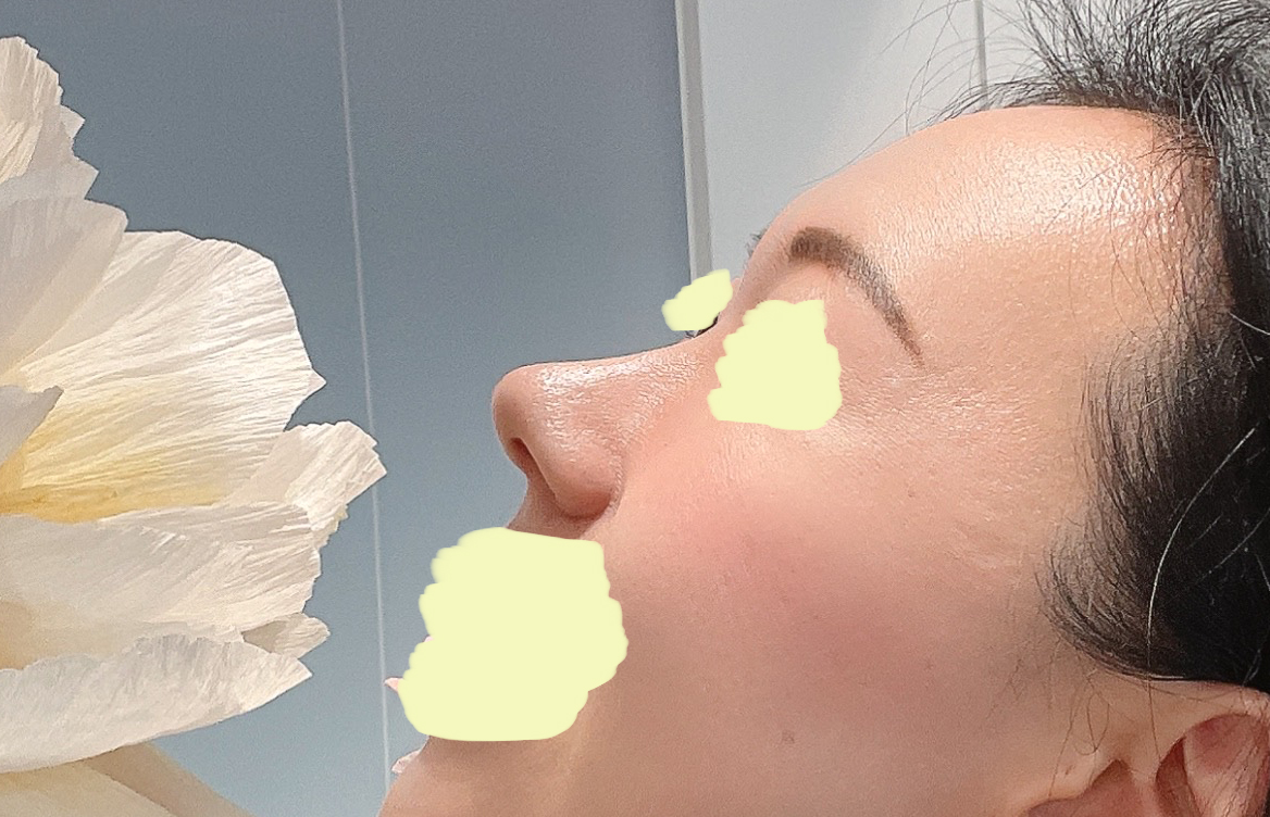 무보형물 코끝성형 성공후기 보고가세용