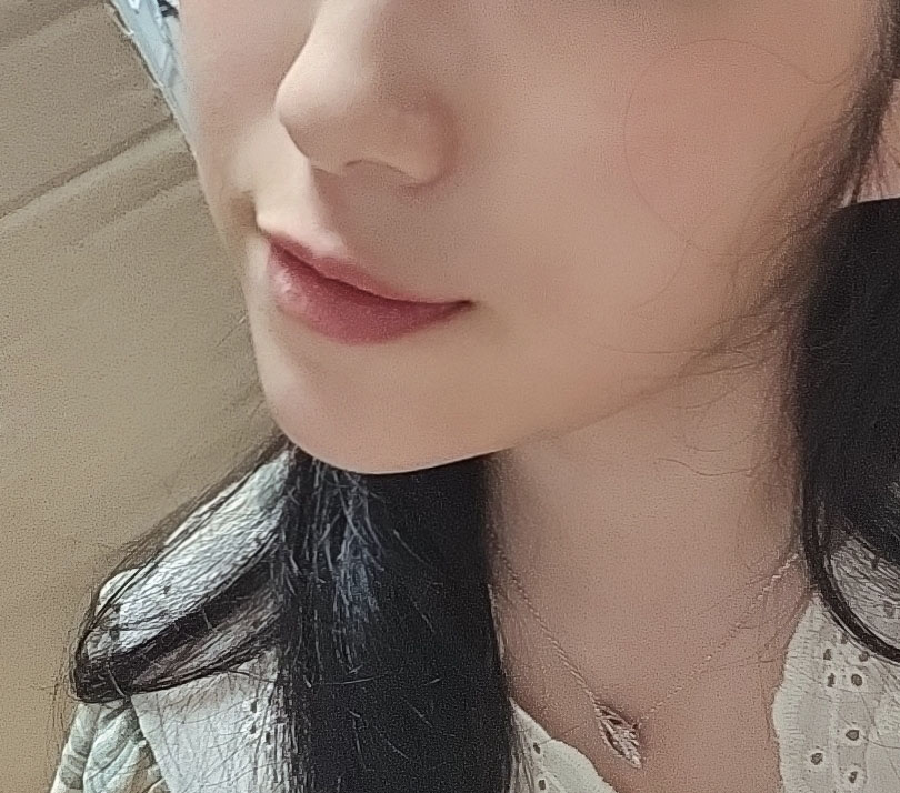 투턱 고민마시구 바이브에서 지방흡입하세용!!