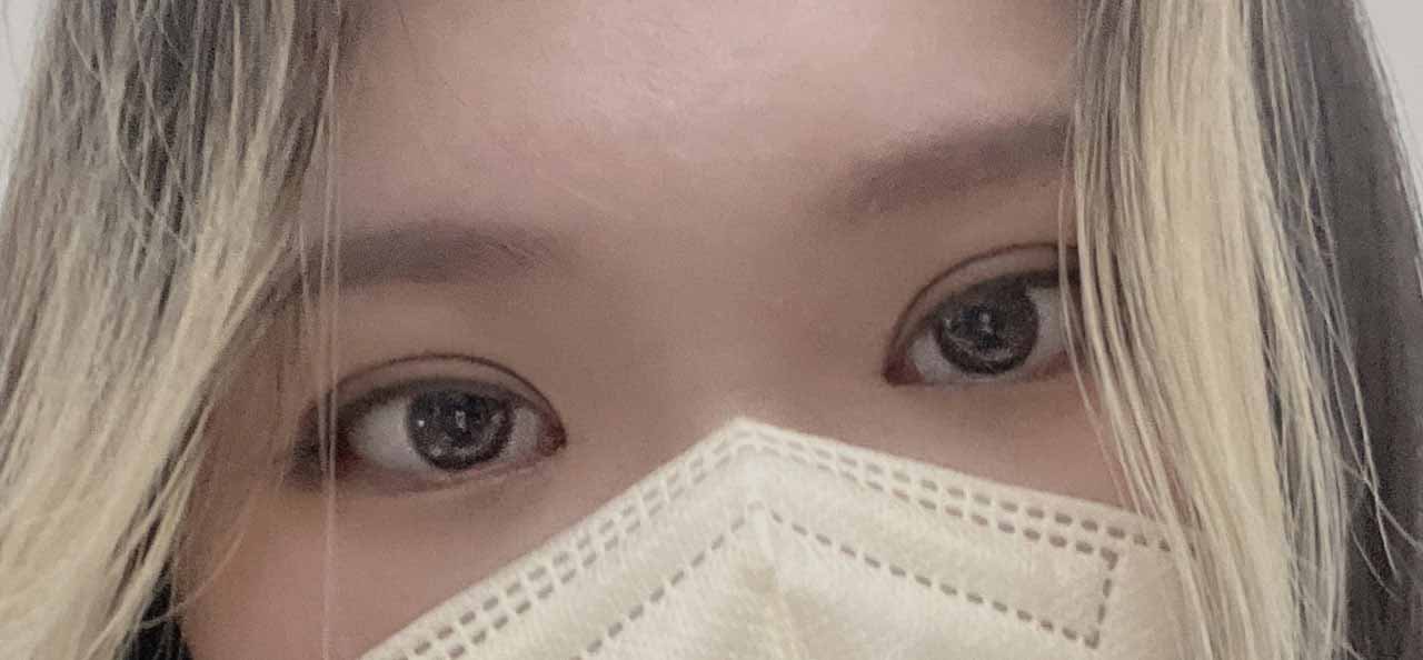 쌍꺼풀수술 내돈내산 후기