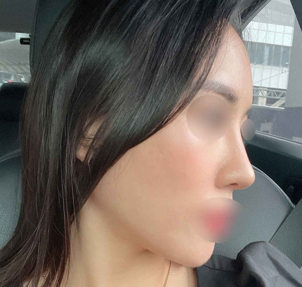 코&풀페이스지방이식수술 6개월후 후기적어요!