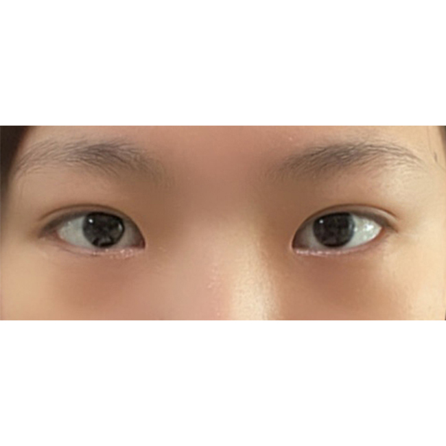 쌍테만 하다가 처져서 눈매교정한 후기