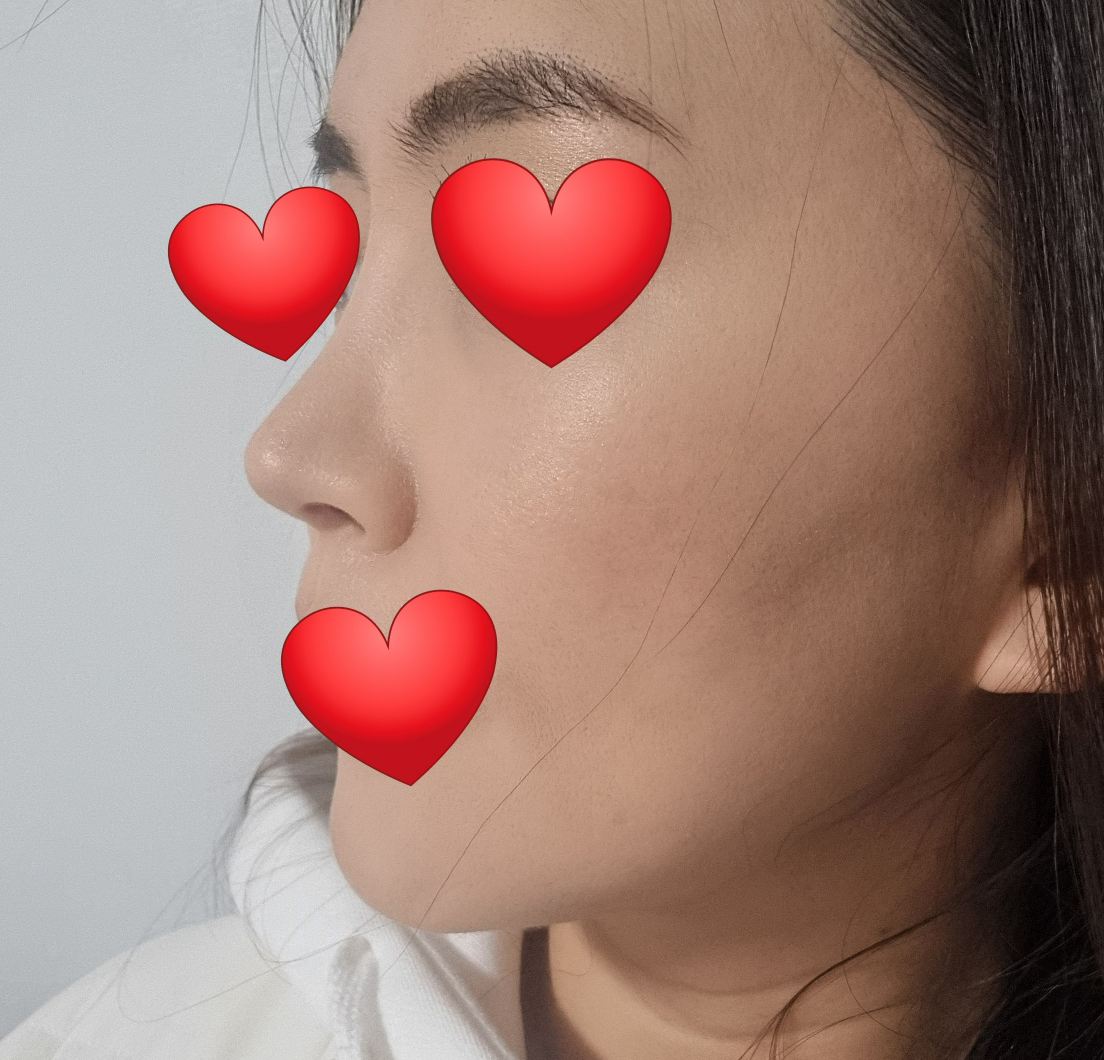 코3번째수술+지방흡입 6개월됐네요!